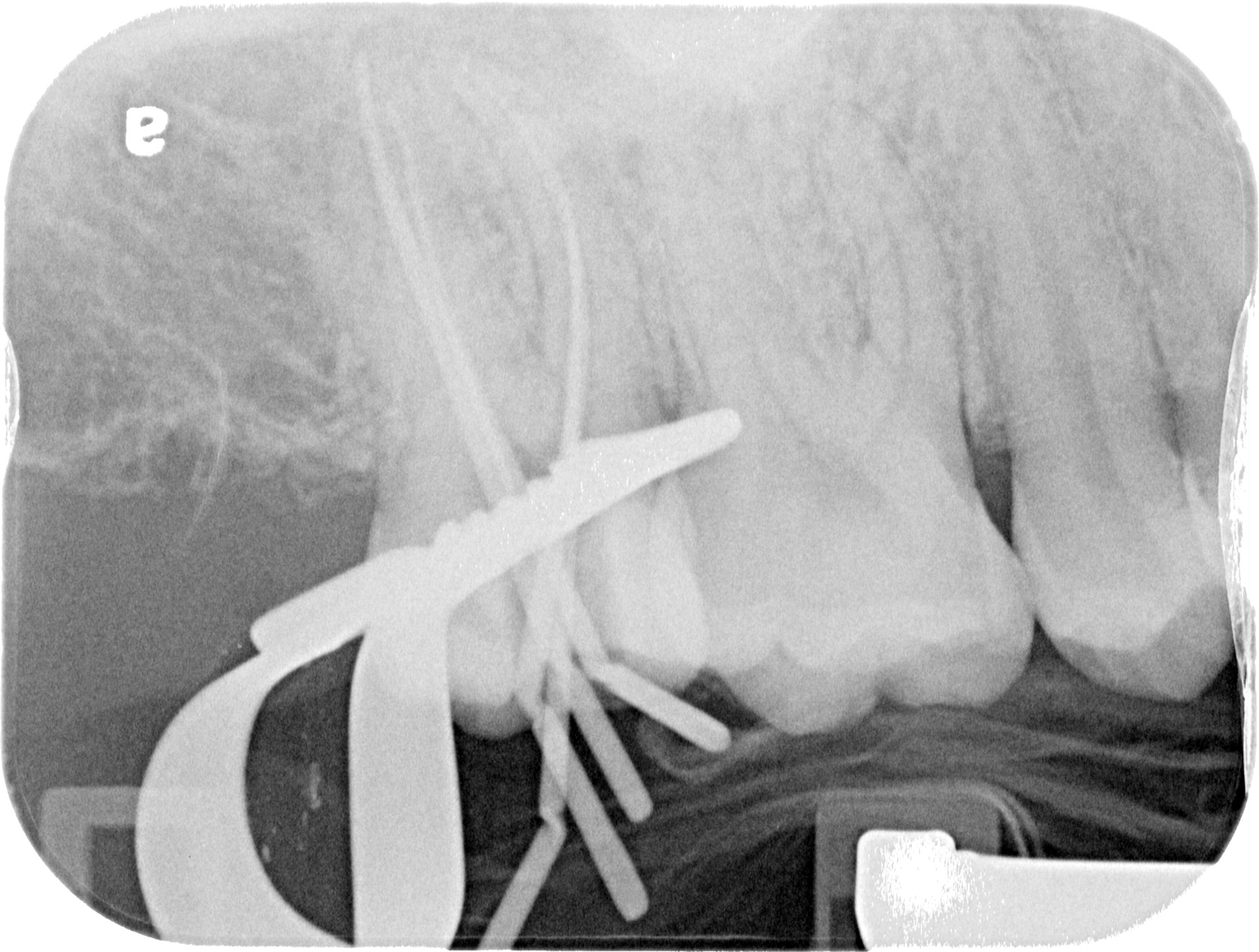 Pre-obturation check