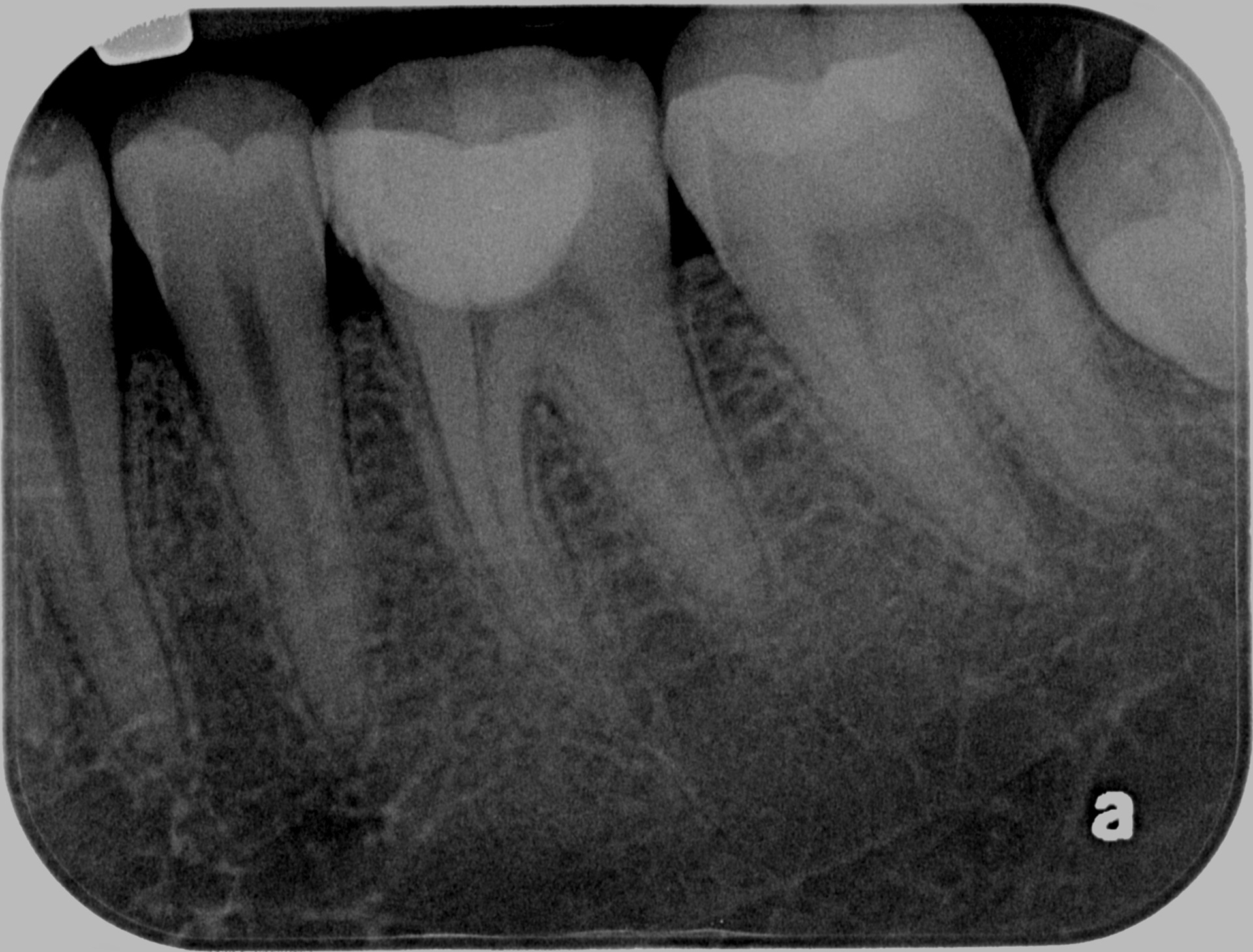 6 months post-op - Is still vital