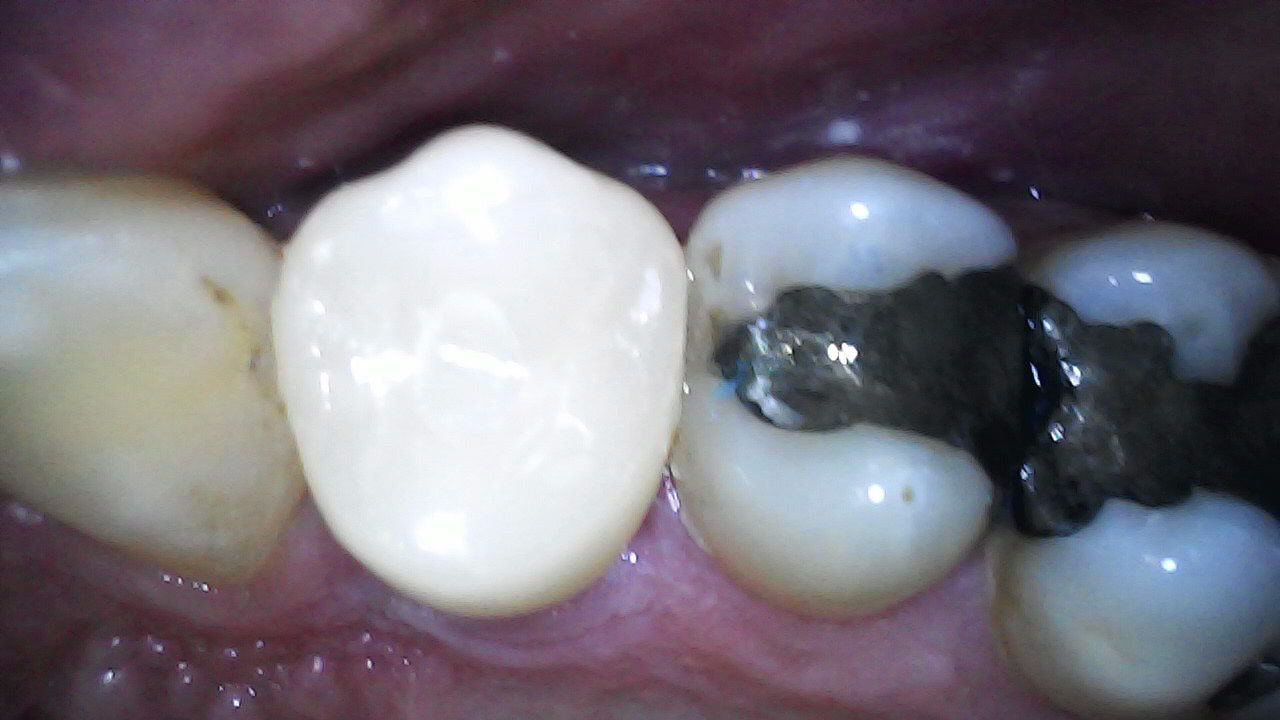 6 month follow-up Access cavity through Zirconia crown