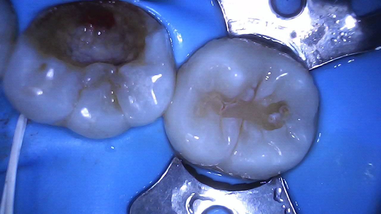 Composite restoration 37 and 36