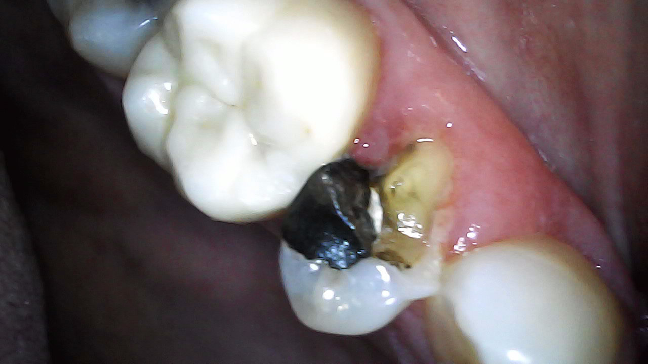 15 Fractured Buccal cusp