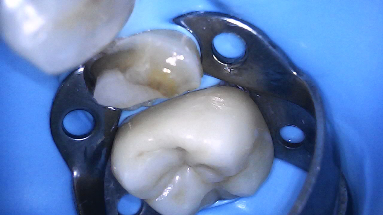 Palatal margin