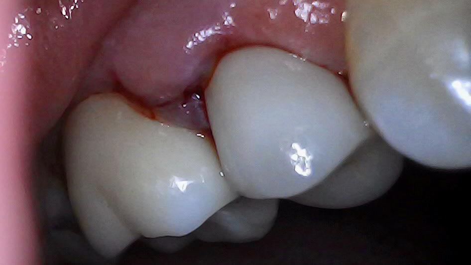 Immediate port-op - Nice shade 