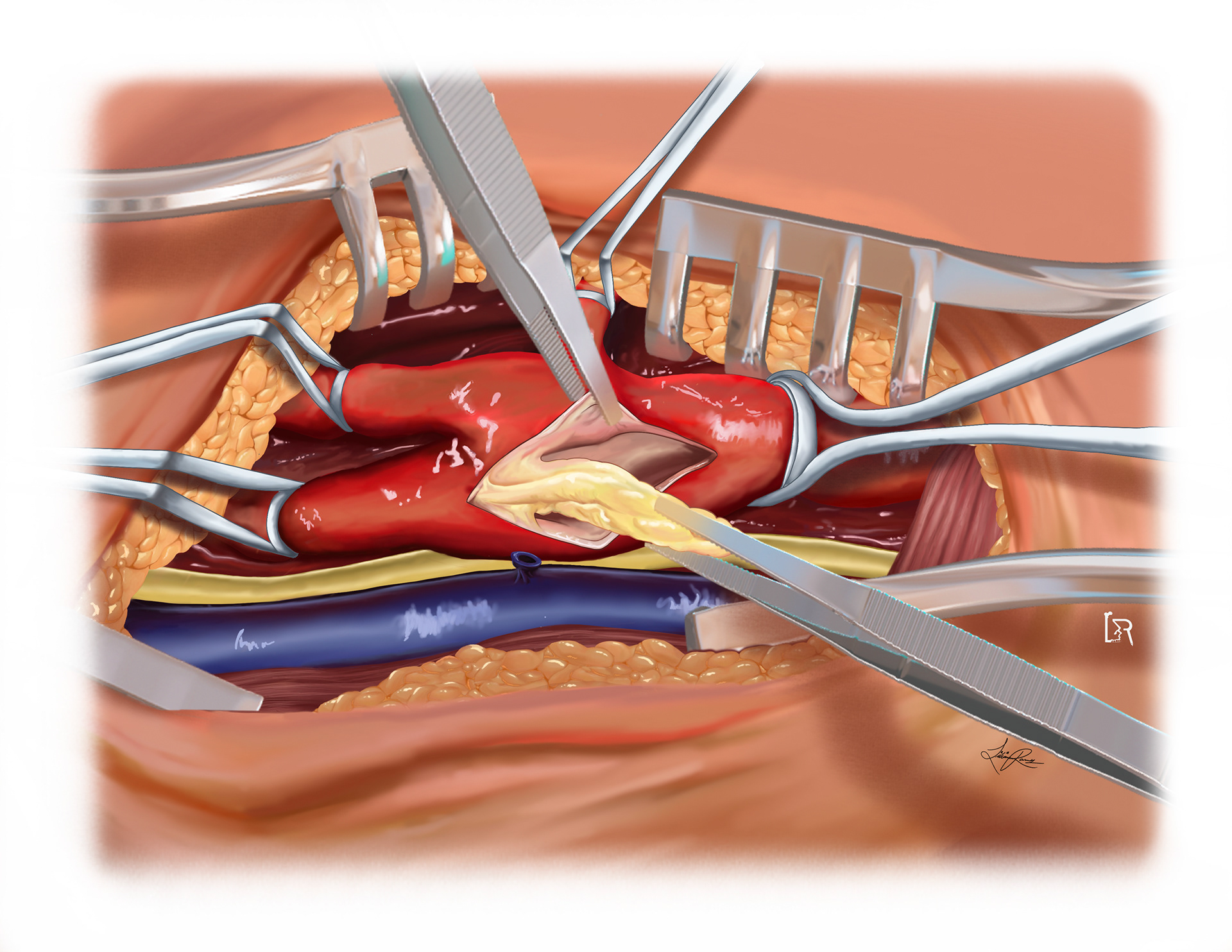 Carotid Endarterectomy Surgical Procedure Step, made in Procreate, Autodesk Maya, Adobe Photoshop and Adobe Illustrator with Pr