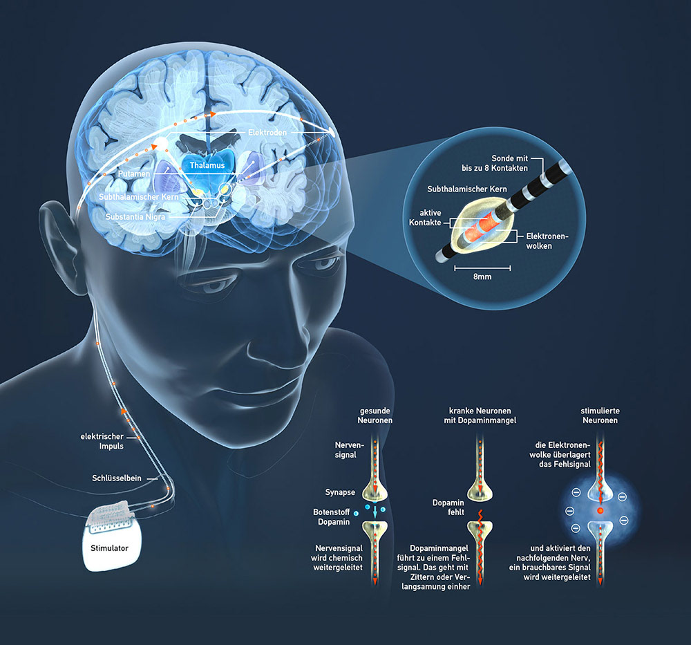 Therapie gegen Parkinsonzittern | GEO 2015
