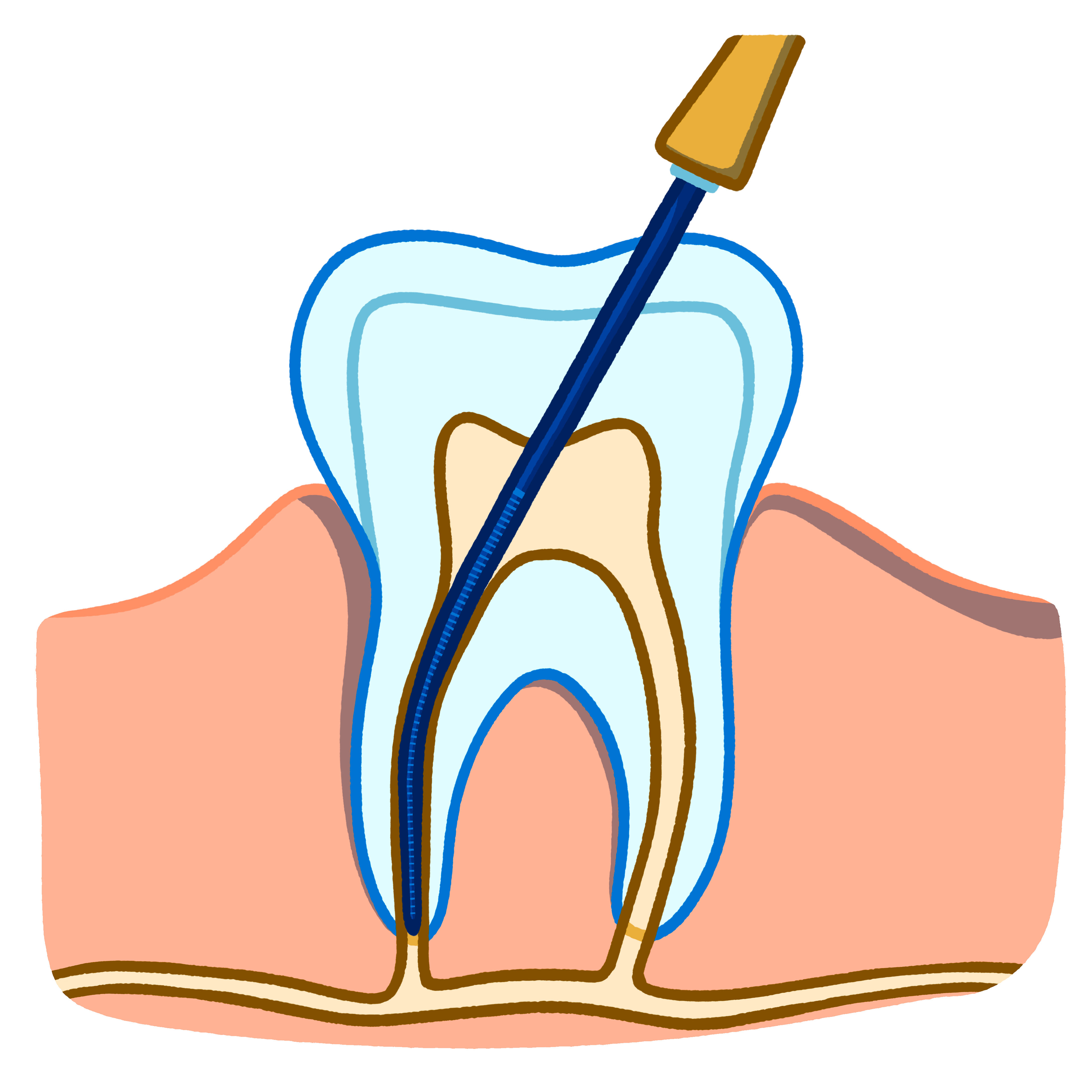 Root Canal Therapy