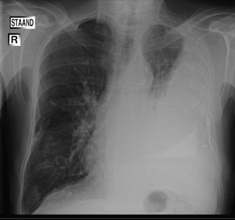 Pleuraal mesothelioom