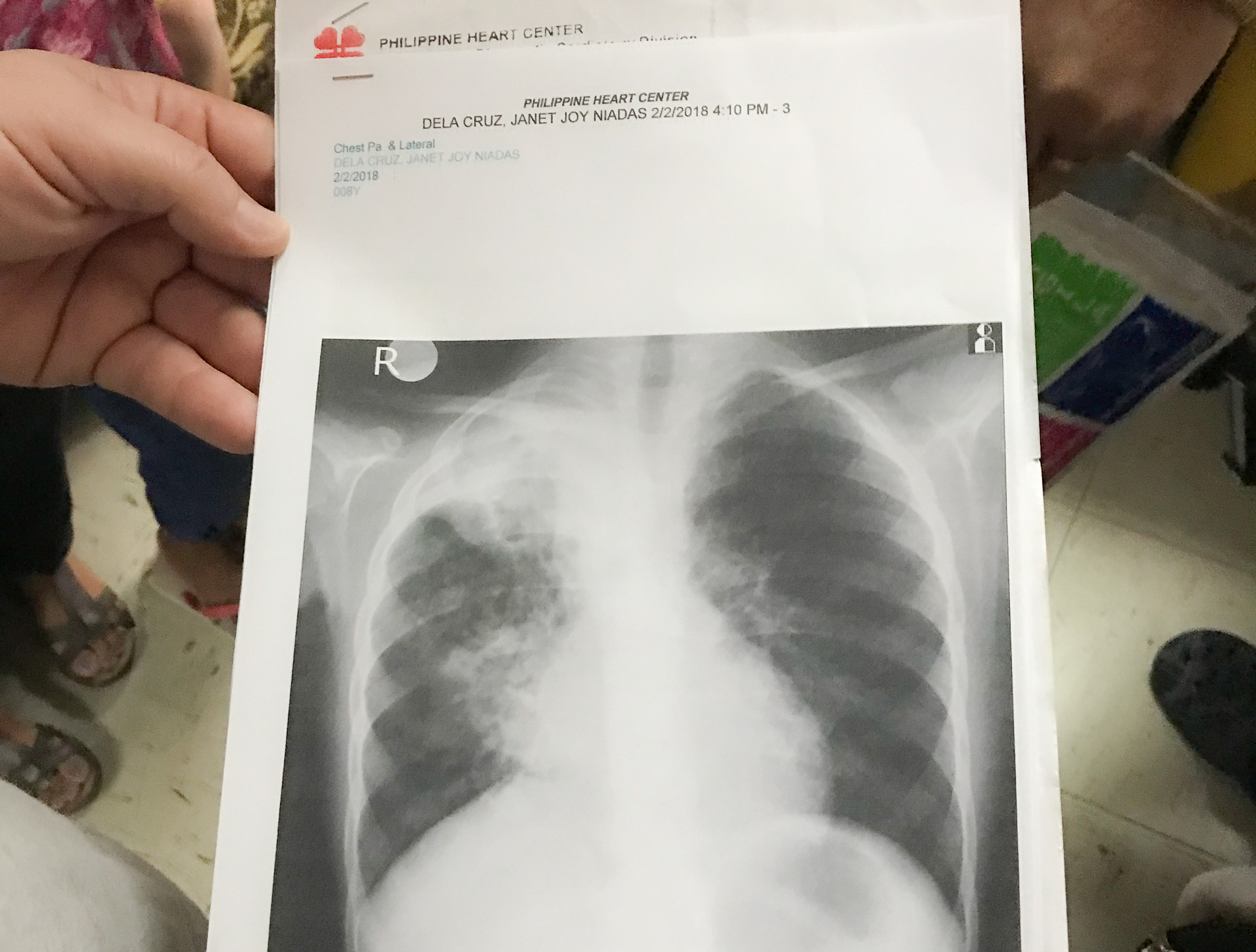 The x-ray of Janet's chest infection.