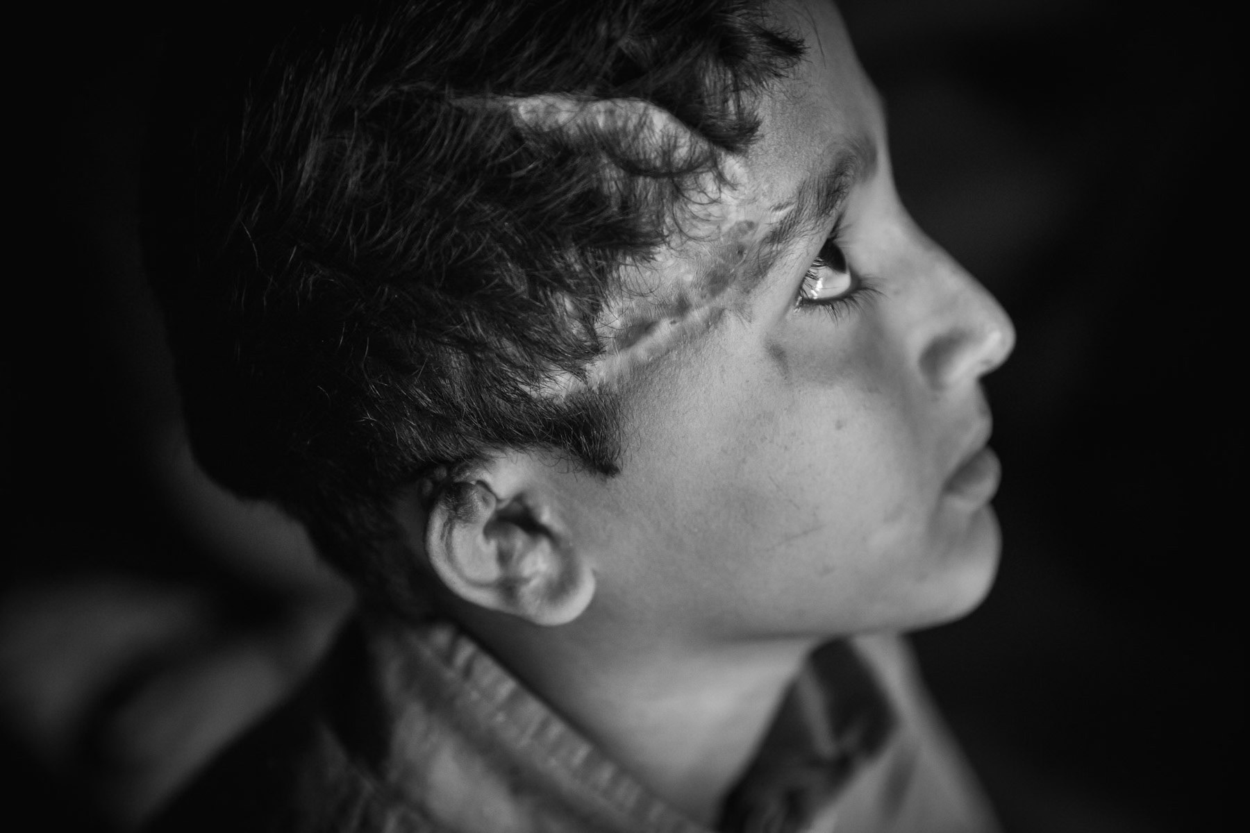 Mohammad Idris, 10 years old from Reskinapara near Maungdaw. He was hit in the head by a lost bullet when the village was attacked. He escaped to Bangladesh with his brother, sisters and parents. Nobody of his family got injured except him. He was for 2 months in hospital after reaching Bangladesh. Lambashiya, Kutupalong, Bangladesh, March 2018