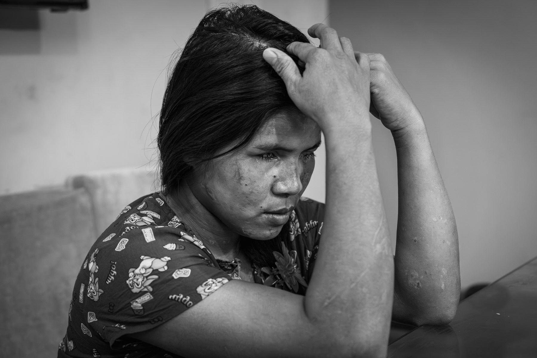 Pamsang, 29 years, is from Matupi in Chin State in Myanmar and was a civilian victim of an airstrike on her house. The military dictatorship carried out airstrikes on 15 November 2023 in Wanglu village near Matupi. Her 3 children, husband and bother in law died instantly. That day 11 people died in the village, mainly young children. She was treated for severe head and leg wounds in hospitals in Mindat and Mandalay before making her way to Aizawl in India for further surgery. Now in New Delhi for eye surgery as she is totally blind since the airstrike. Her right eye is lost and a marginal sight recovery on the left eye has occured since the eye surgery. The military regime in Myanmar has systematically used air strikes on civilian populations, schools and medical facilities without any military goal except traumatising the population and committing relentless unpunished war crimes. Chin community safe house in New Delhi, India, May 2024