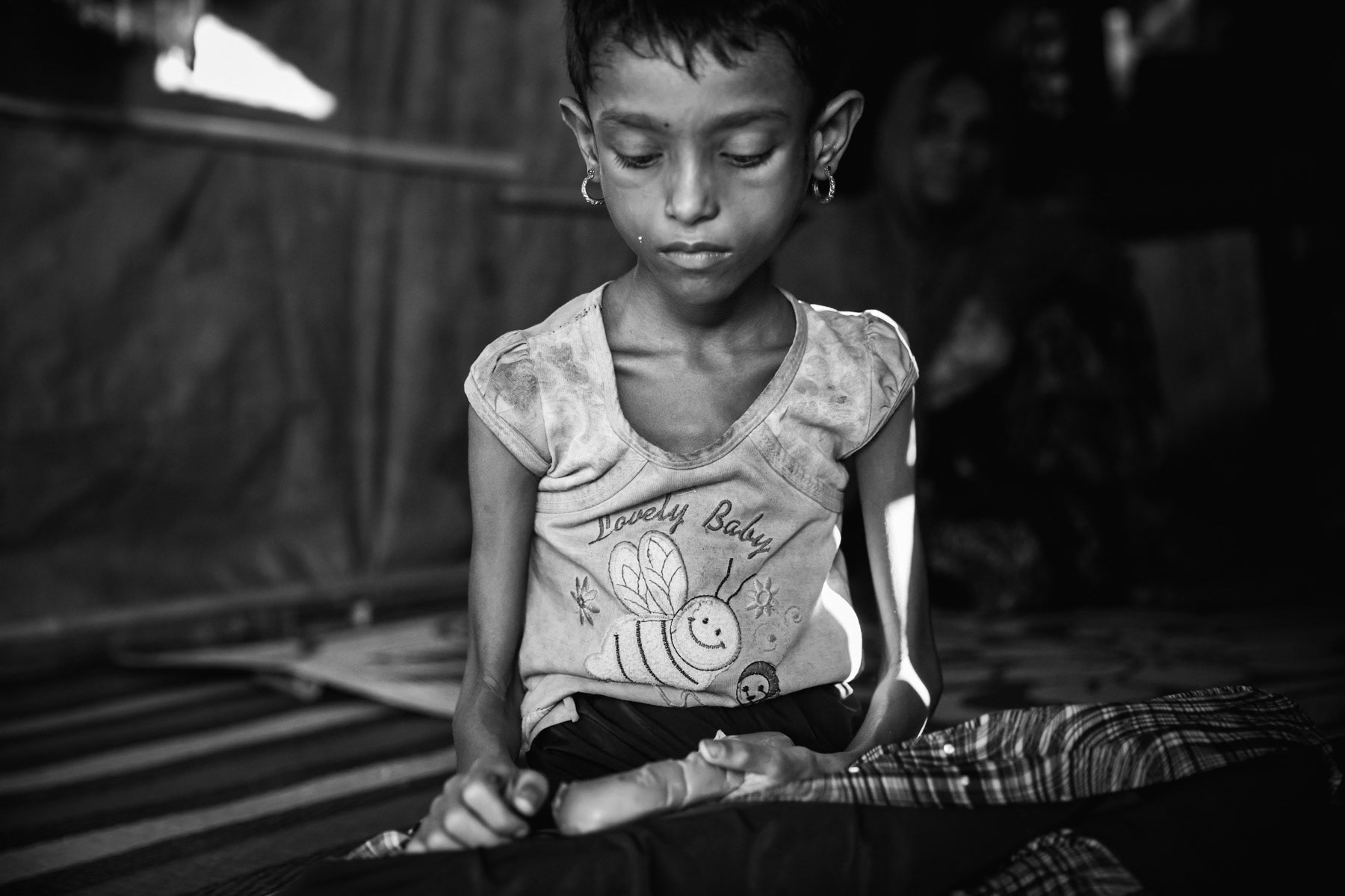Azida Bibi, 6 years old Rohingya refugee from Sanifara near Maungdaw in Myanmar. She was snatched in her village on 1 September 2017 by Burmese military and forced to drink battery acid. Ever since she has lost more than half her weight as she can't digest any food and is vomitting constantly. She fled immediately after the attack to Bangladesh where she is being treated in a clinic. An estimated 650,000 Rohingya have fled persecution since August 2017 and a widespread security operation carried out by the Myanmar military. Human Rights groups and the UN have called those operations ethnic cleansing campaigns evolving into genocide. Balukhali refugee camp, Cox's Bazar, Bangladesh, November 2017