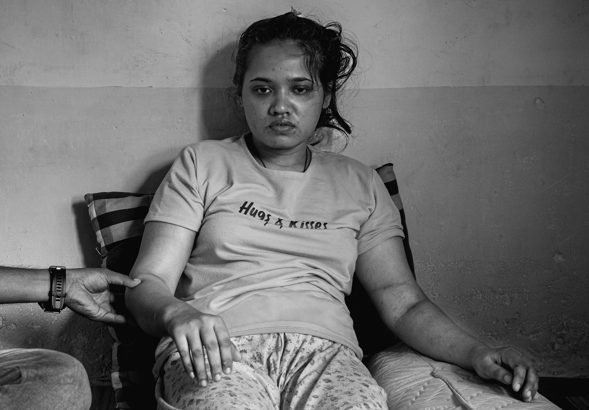 Harasa Bibi arrived in Indonesia in December 2025 via the Dumai trafficking corridor. After being separated from her travel companion, she was held by traffickers who subjected her to systematic torture, including cigarette burns and physical assault, and raped her when ransom demands were not met.Traffickers eventually abandoned her on a bus to Pekanbaru. Following a brief hospitalization for severe trauma and shock, she was released under heavy sedation. Currently, Harasa is unable to speak or walk and suffers from persistent fever. Her sister and brother-in-law traveled from Malaysia to provide care in a rented house, where she remains in critical need of specialized medical and psychological intervention. Pekanbaru, February 2026