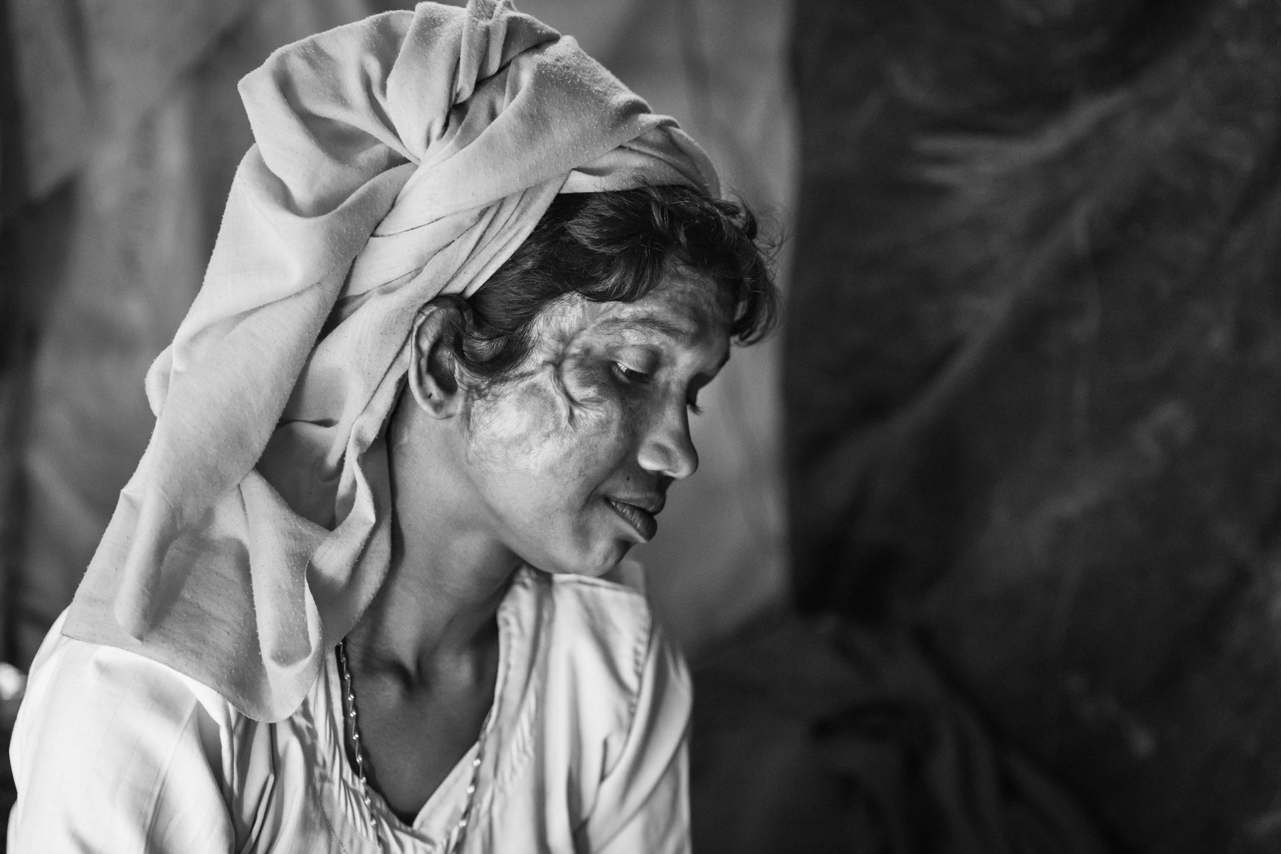 Momtaj Begum, 30 years old and her sole surviving child, Ruziya, 7 years old from Tula Tuli village in Maungdaw township. Tula Tuli village was attacked by Myanmar military forces on 30 August 2017 and survivors have witnessed extreme atrocities committed by military forces that international human rights groups have called brutal ethnic cleansing with possible genocidal intent. Momtaj Begum had 3 of her four children and husband executed and decapitated in front of her. She was consequently raped in front of her sole surviving daughter who was assaulted with a machette and left for dead. After the rape and the killings the house was locked by the military and set a blaze. She managed to escape with her daughther who had severe head wounds through the back door, while the military stayed in front of the burning houses. Doing so she was severely burned on more than 80% of her body, her daughter has several machette wounds on her skull. They arrived 5 days later in Bangladesh where she stayed one month in the MSF hospital. Her husband and 3 other boy children of 9,11 and 12 years were all burned in the house after being killed. Since our last meeting in November, they continue to struggle and to suffer as a result of the wounds and trauma. Going to the clinic to get care is challanging as it take 1$ for the trip and queues of more than one day. Also to collect the food rations she has to send her daughter as she has difficulties to walk. Her only surviving daughter has further head aches as a result of the machette wounds to her skull. Balukhali refugee camp in Bangladesh, March 2018