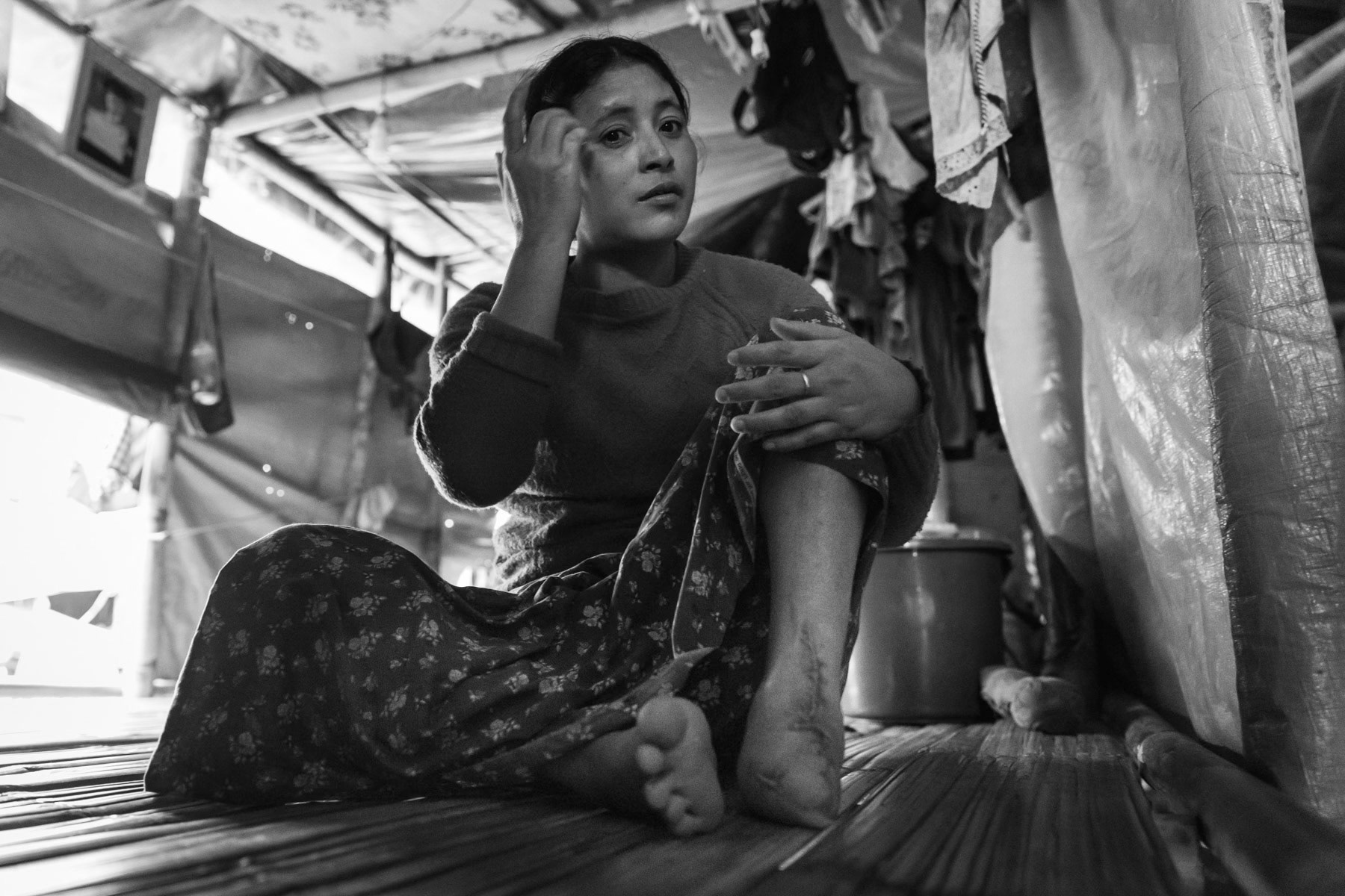 Land mine victim, 35 years, stepped on a land mine in March 2019 when returning to her village, Zup Mai, to collect wood with 4 other villagers. She had been displaced from the village since April 2018. Was treated in Myitkyina hospital and received a prothisis from ICRC in June 2019. The mine was on the main road at the exit of the village and has most likely been put there by the Burmese military after the conflict of April 2018. Landmines is one of the main reasons why people cannot go back to their villages. Myo Oo IDP camp, Namta, Kachin State, Myanmar, September 2019