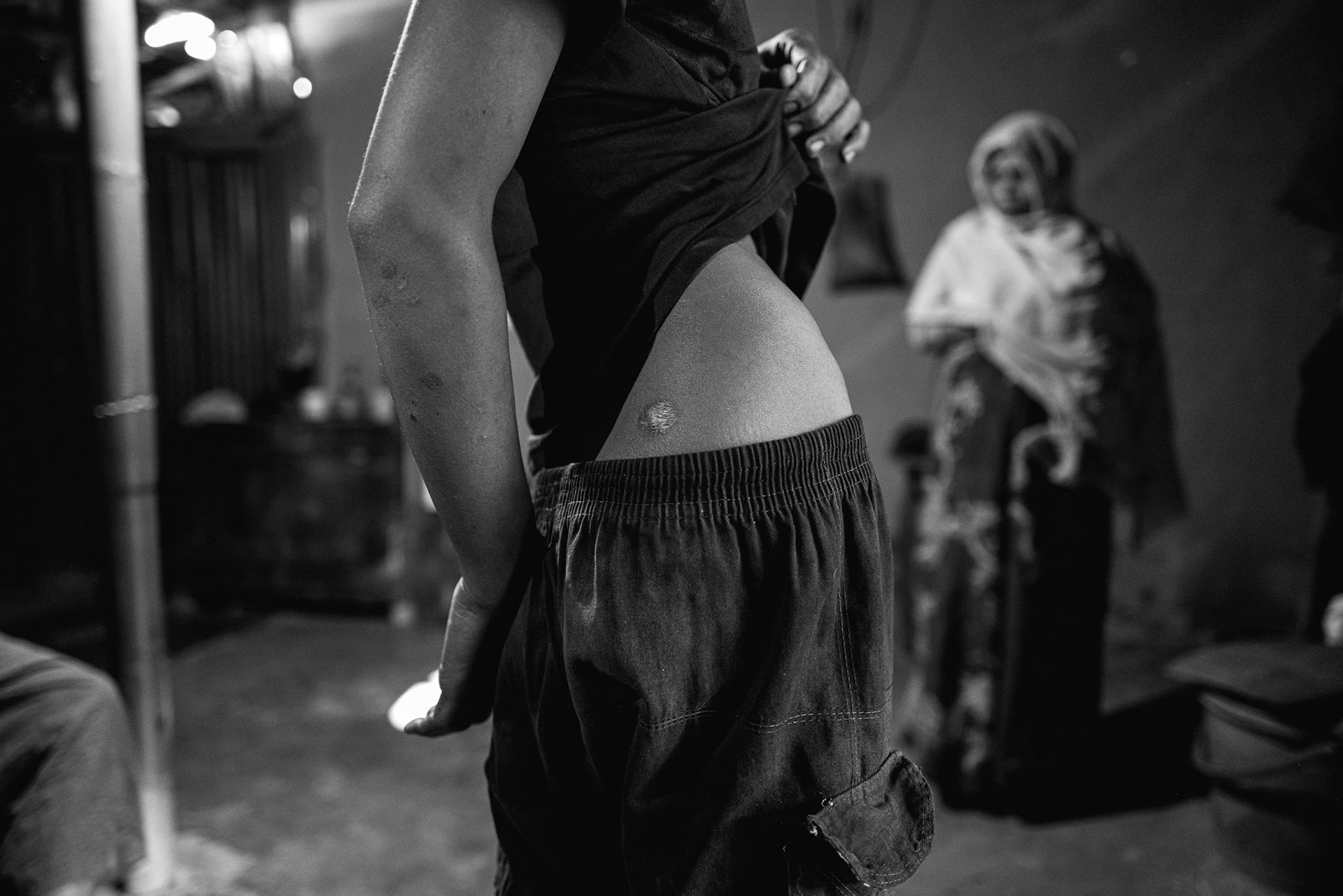 This close-up captures the shrapnel wounds sustained by 13-year-old Aji Nur during a 2024 Arakan Army drone strike in Maungdaw downtown. Aji Nur, who also lives with mental health challenges, was one of four family members injured in the blast that instantly killed his father, Md Isaak (45).Alongside his mother, Morijan (42), and his surviving siblings, Aji Nur is now a refugee in Balukhali camp, where the family continues to deal with the physical and psychological scars of the attack. Balukhali camp in Bangladesh, January 2026