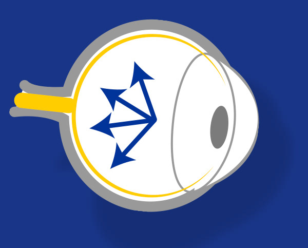 Glaucoma