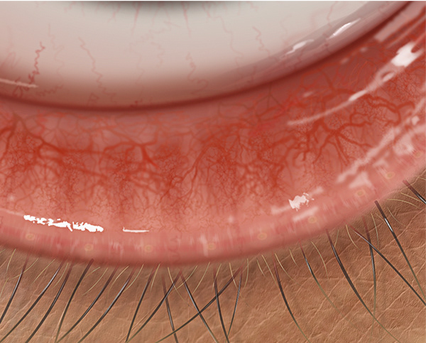 Vascular engorgement of the tarsal region