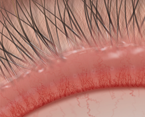 Vascular engorgement of the upper lid