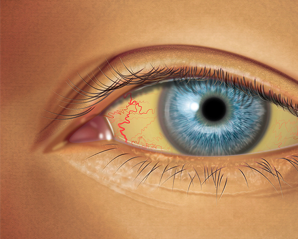 Scleral Icterus (Jaundice)
