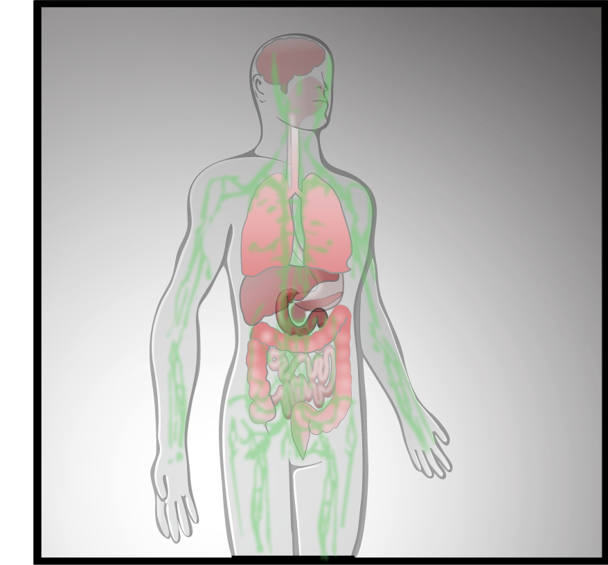 Metastasis of duodenal carcinoma