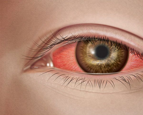 Episcleritis