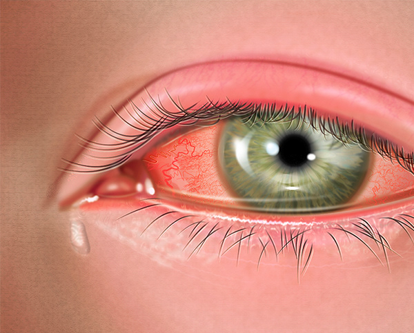 Viral Conjunctivitis