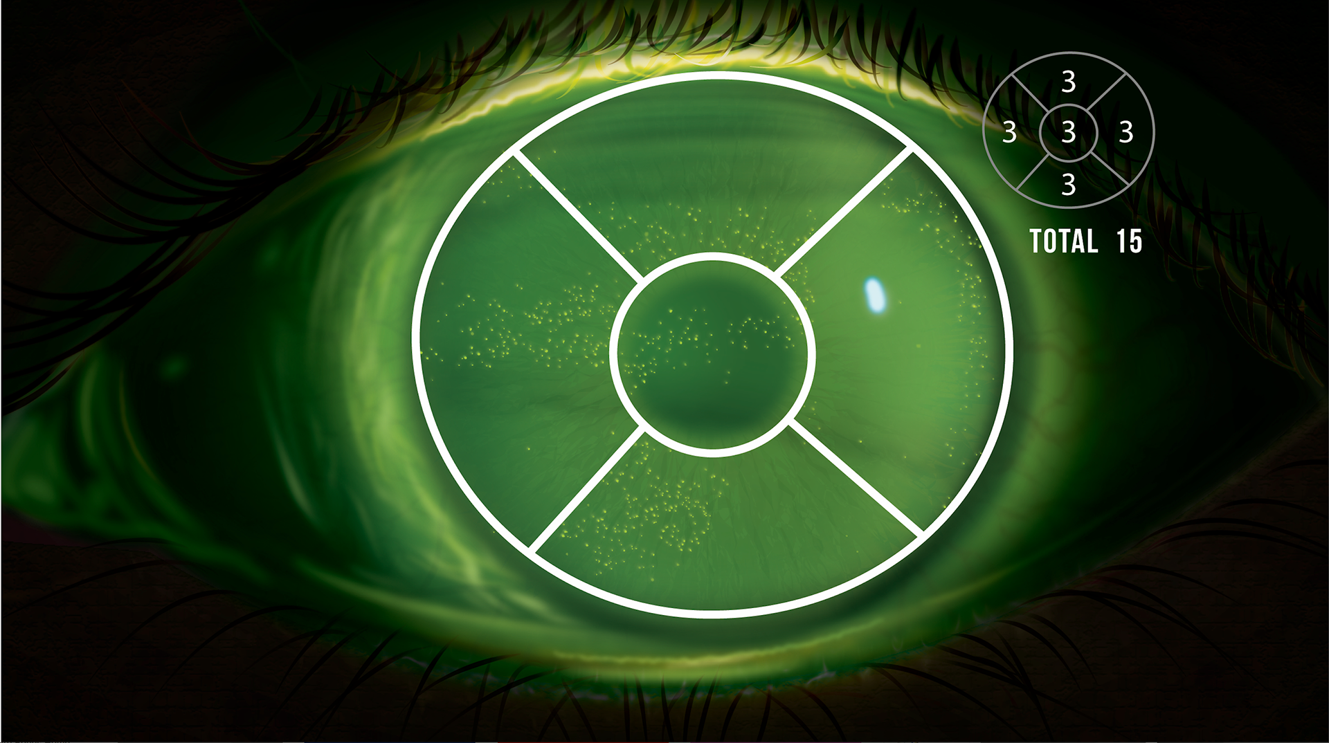 Corneal Fluorescein Staining