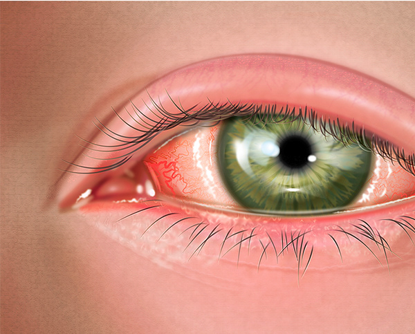 Allergic Conjunctivitis