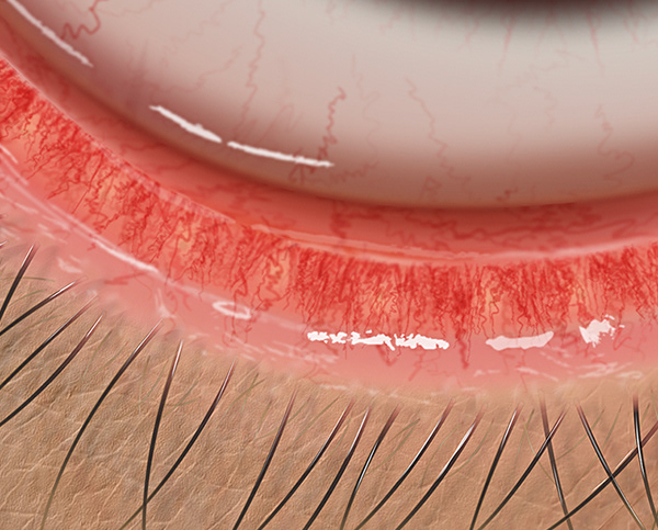 Vascular engorgement of the lower lid