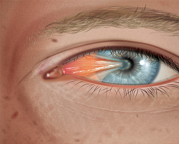 Pterygium