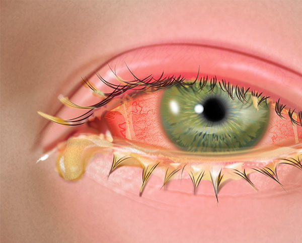 Bacterial Conjunctivitis