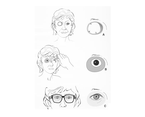 Prosthetic Eye Fitting