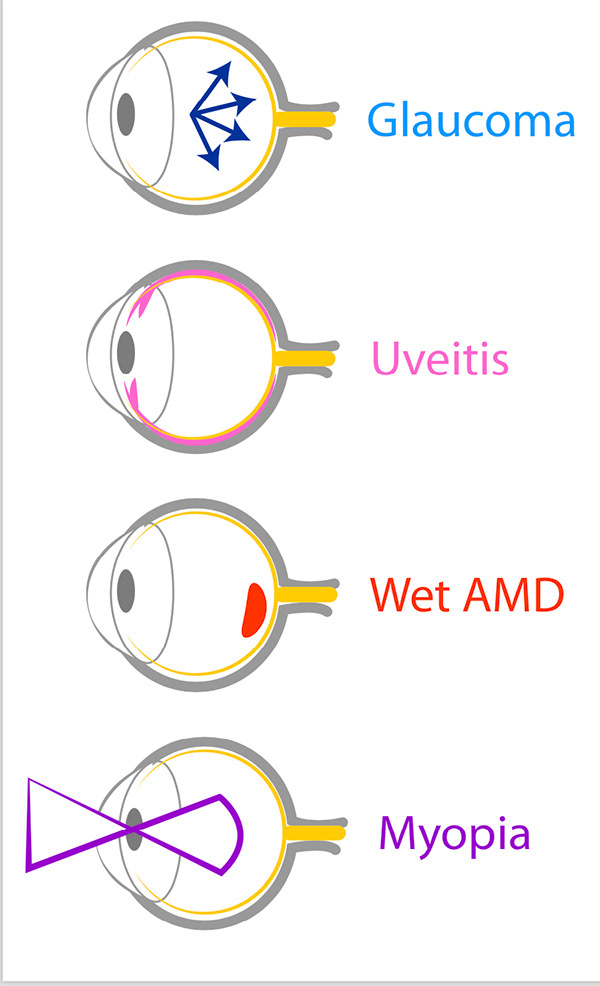 Eye Conditions