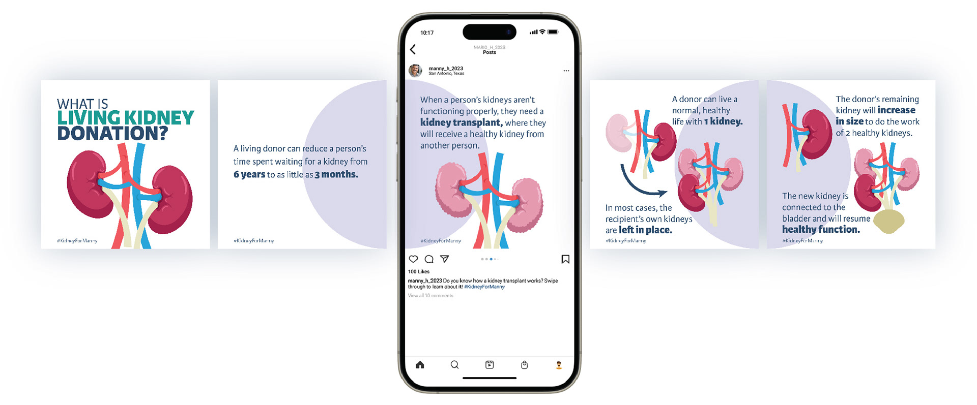 Social media template explaining the kidney transplant process