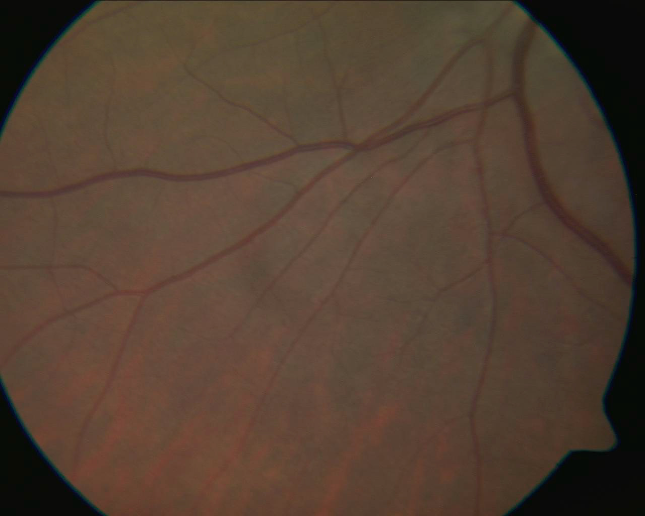 Inferior Nasal