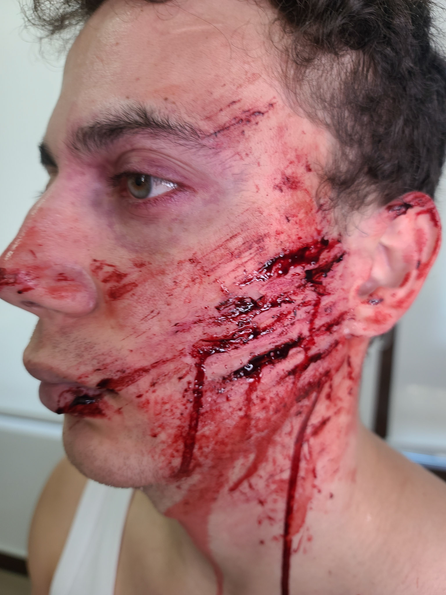 Injury + Bruises