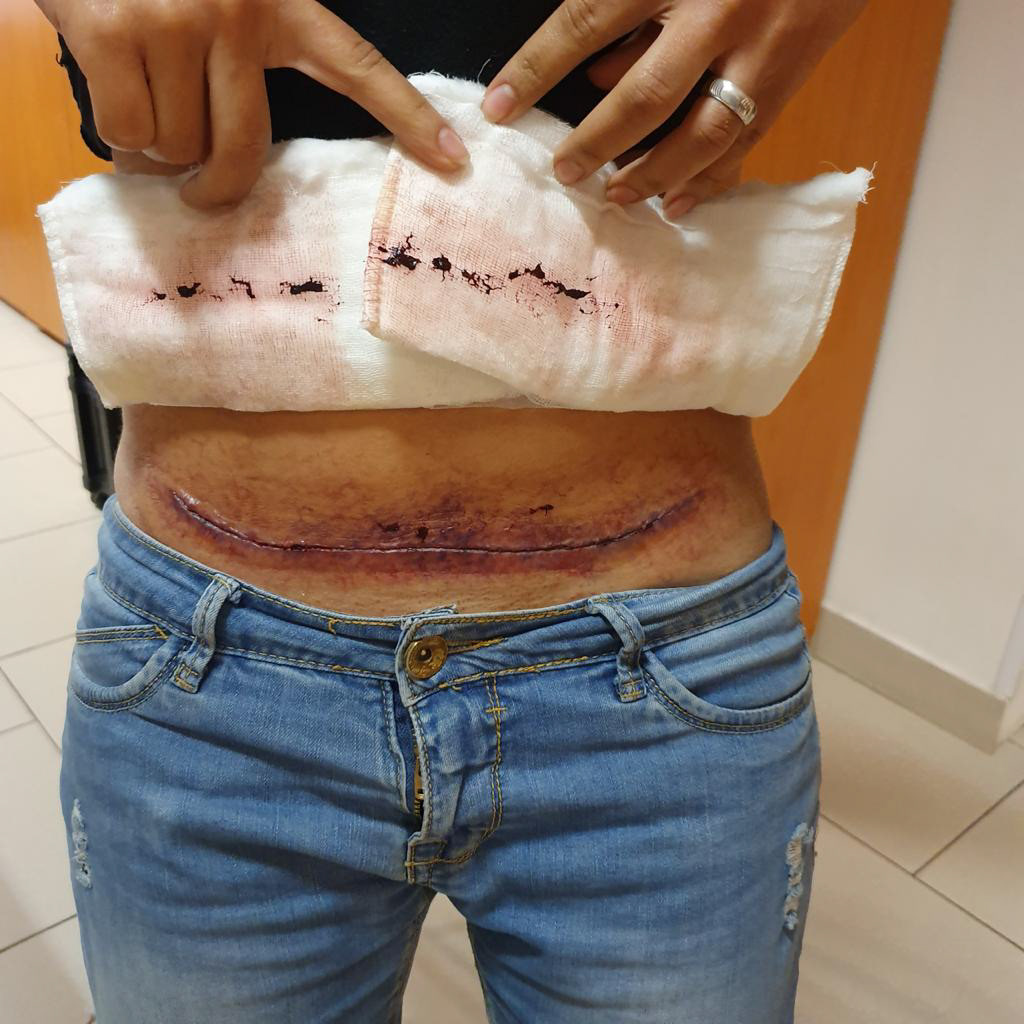 Injury After Surgery