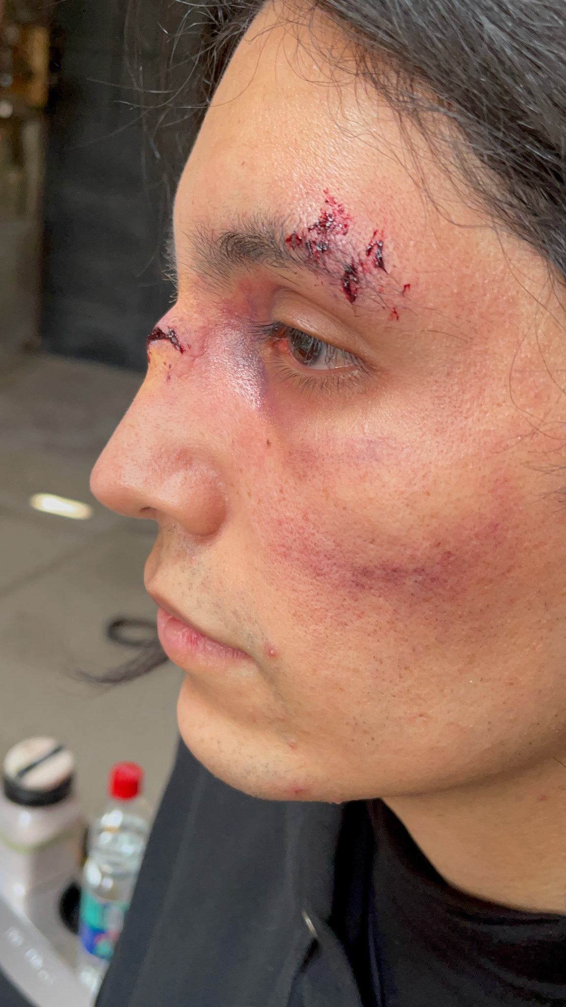 Broken Nose and Bruising