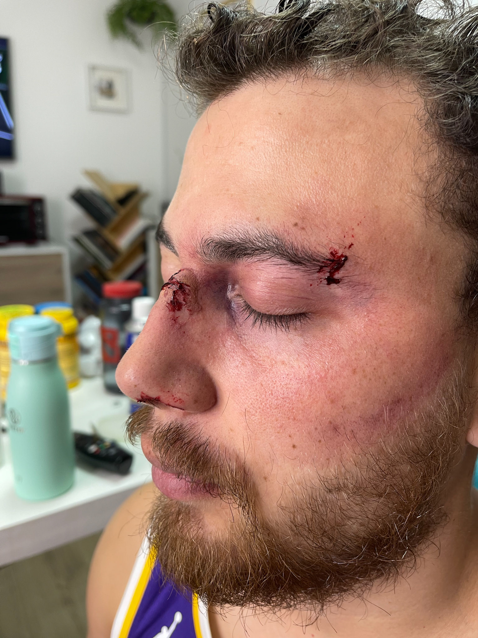 Broken Nose and Bruising
