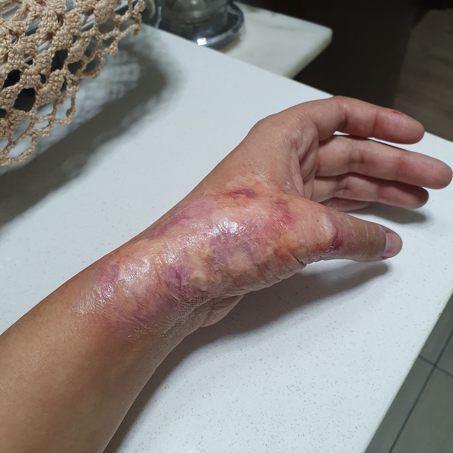 Burn (Silicone + Baldiez)