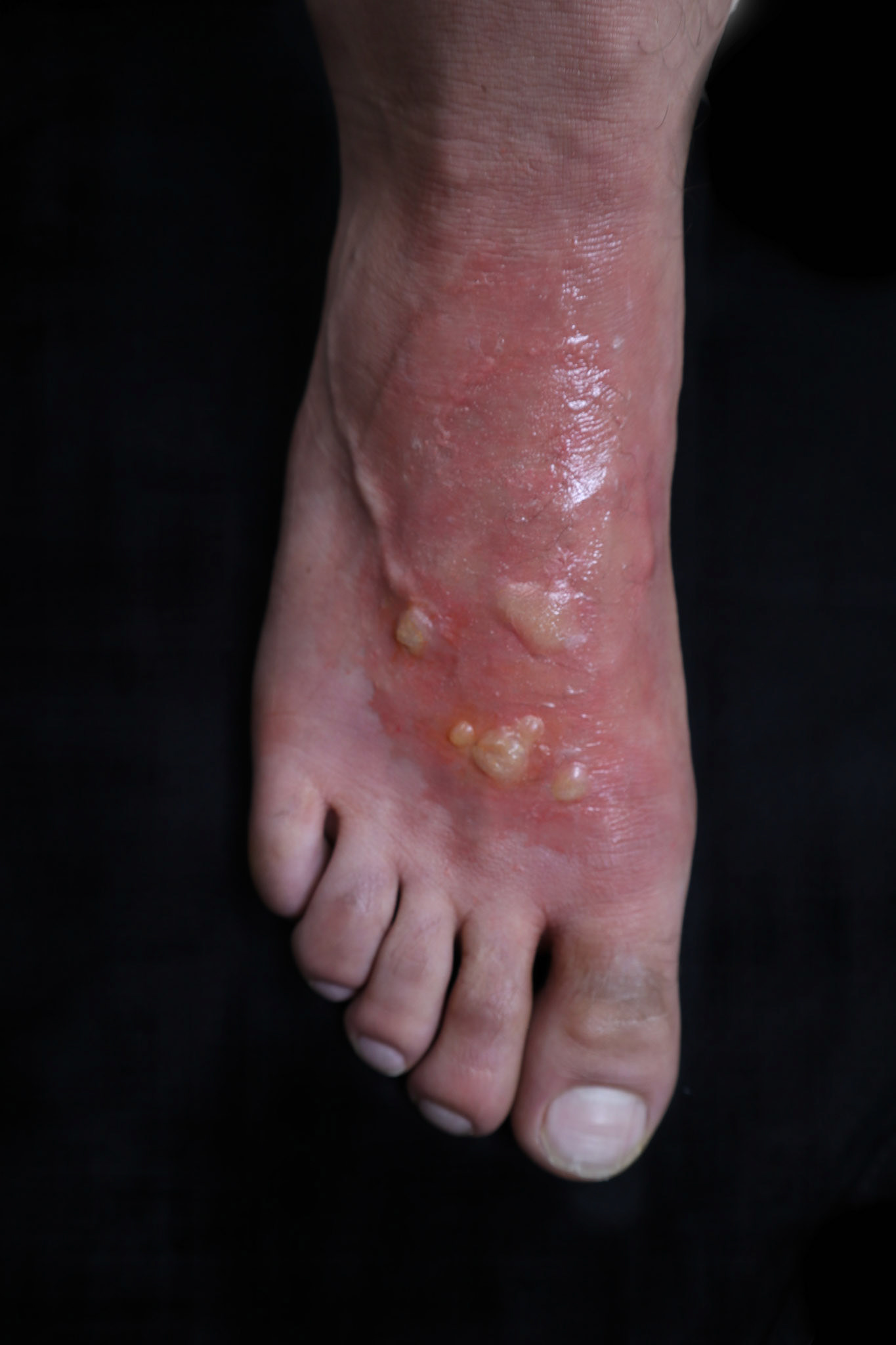 2nd Degree Burn