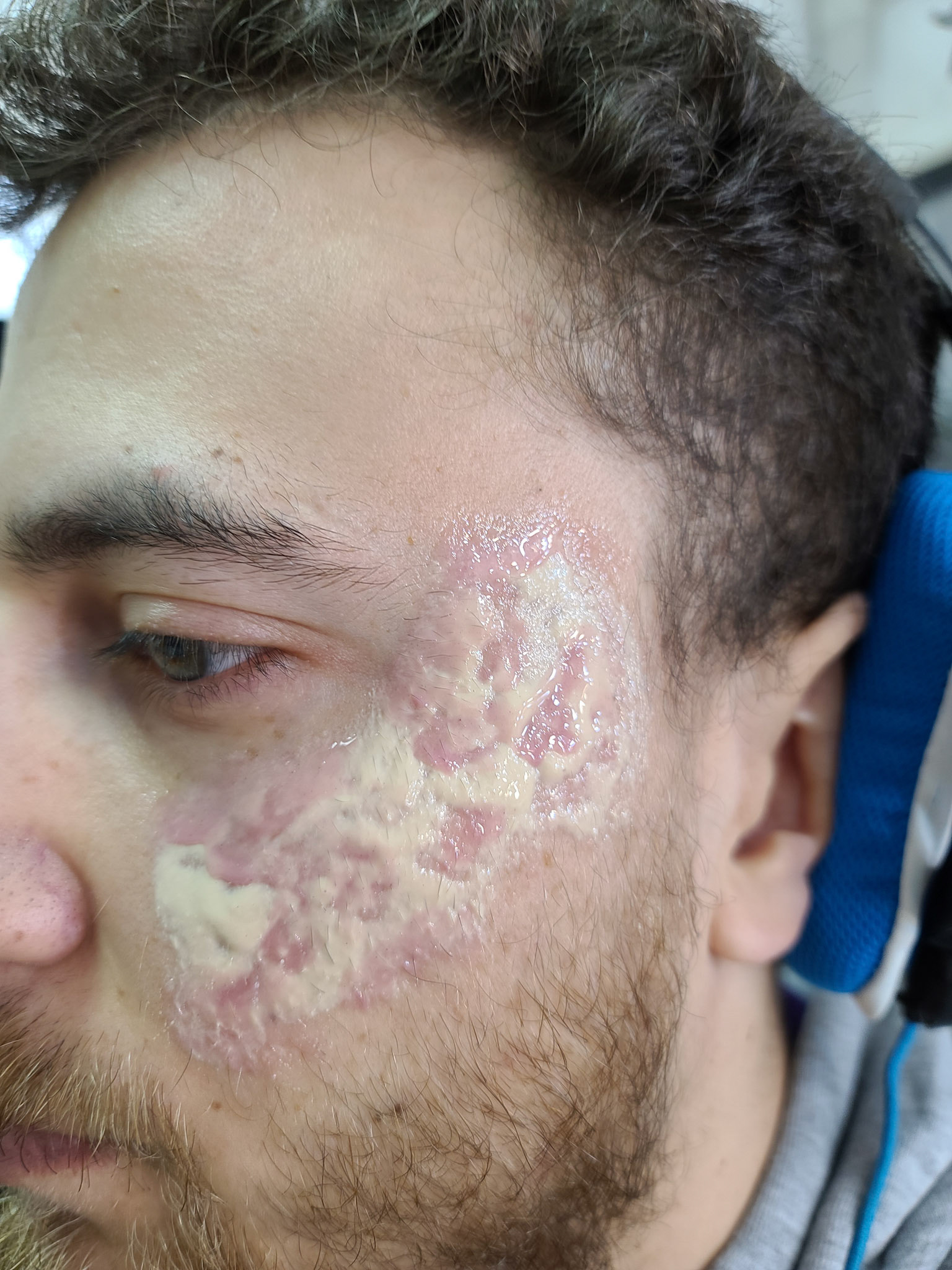 Burn (Silicone + Baldiez)