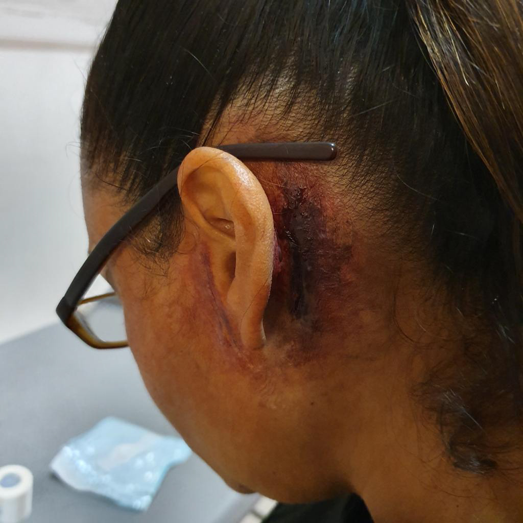 Injury After Surgery