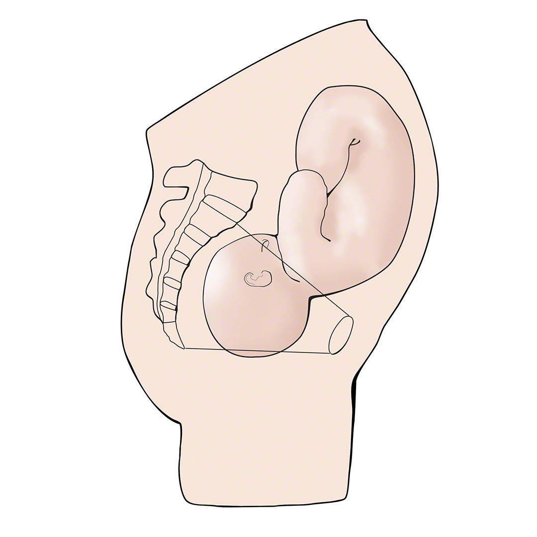 Cross section of fetus in pelvis showing fetal head engagement