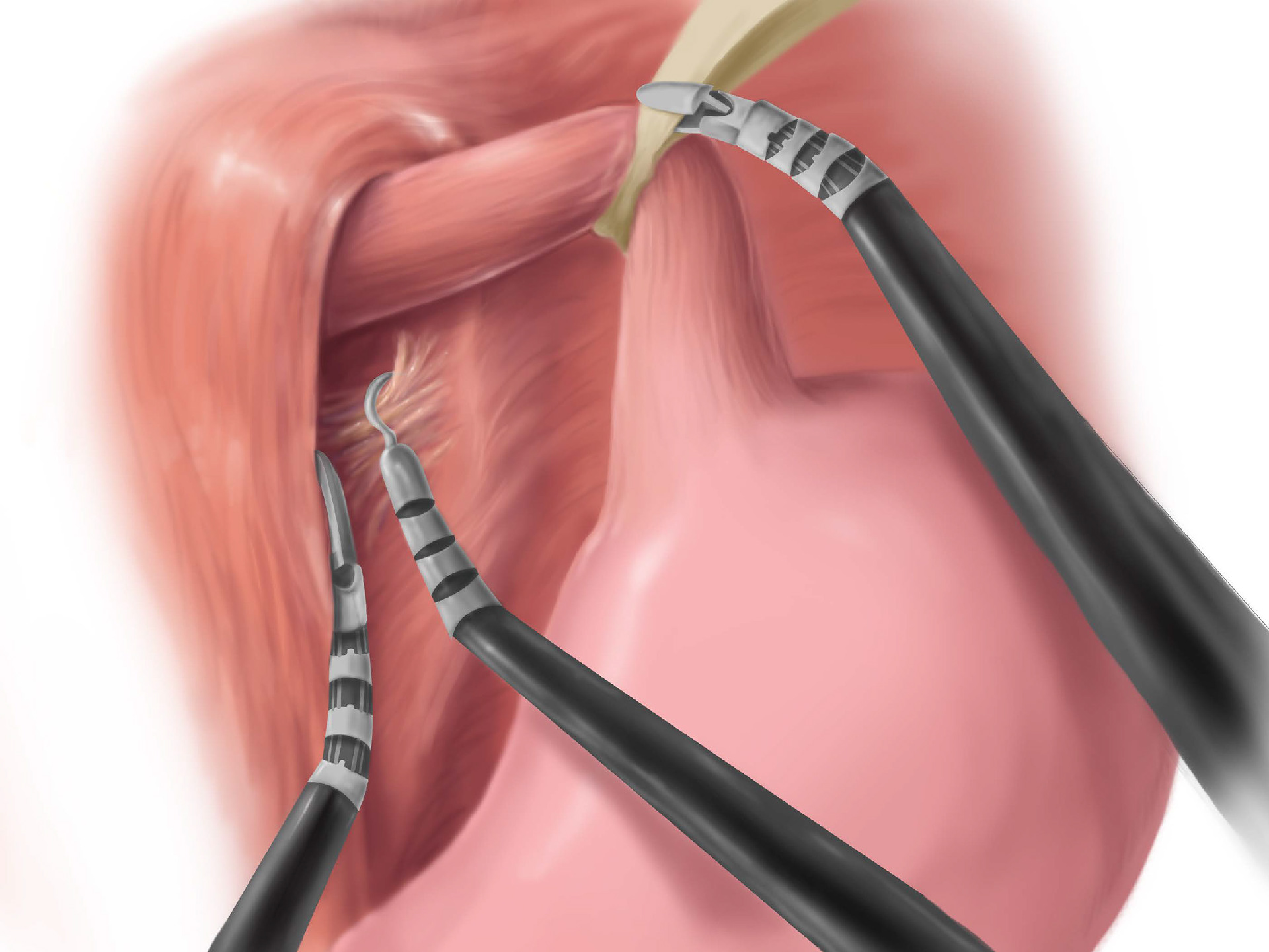 Sierra Snipes Nissen Robotic Fundoplication