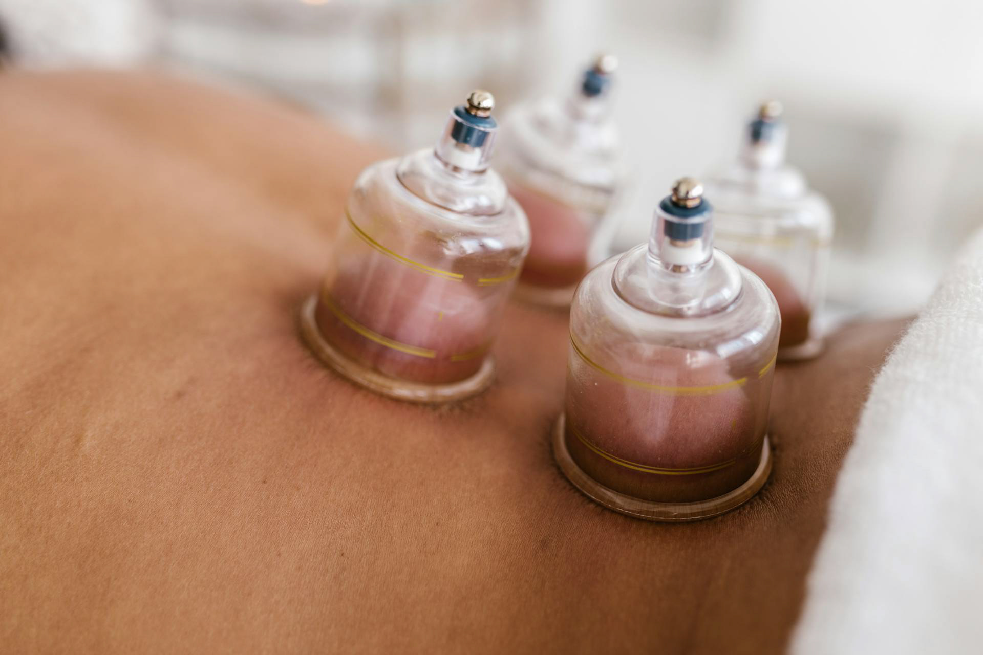 Pain Reduction with Cupping