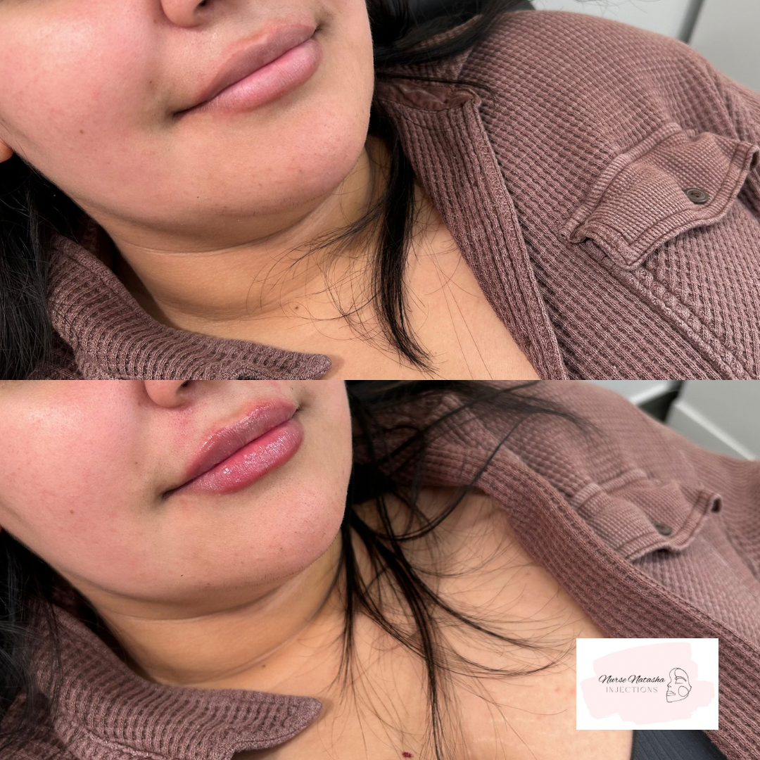 Top photo half syringe of lip filler healed, bottom photo after another half syringe of lip filler added