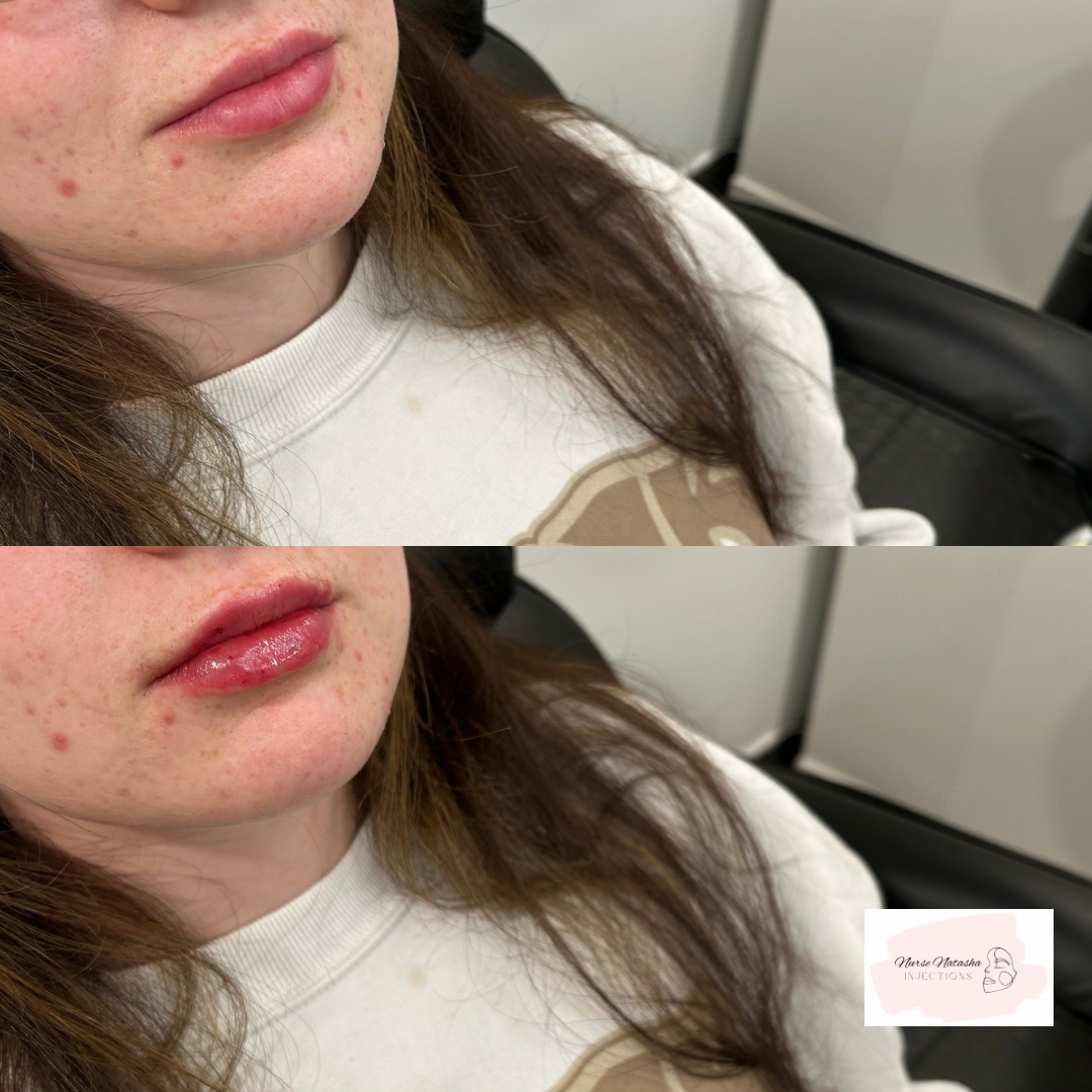 Top photo full syringe healed, bottom photo another 1/2 syringe added