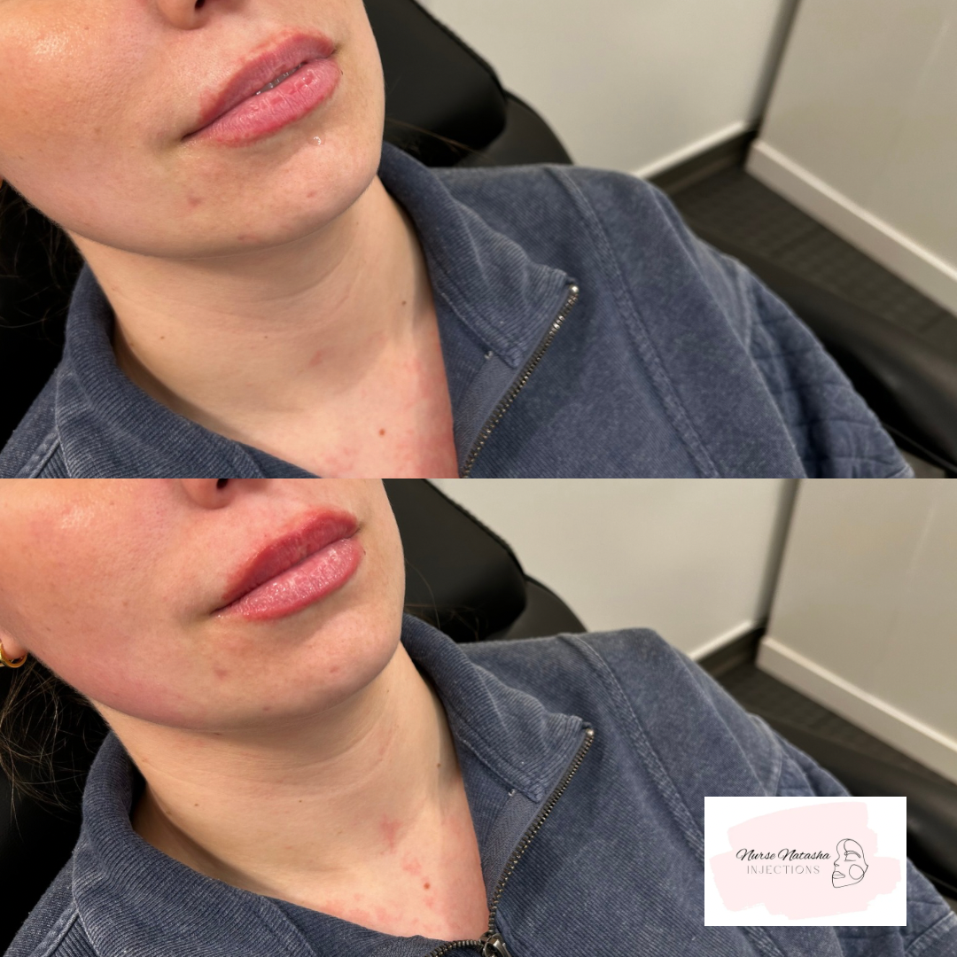 1/4 syringe to top lip