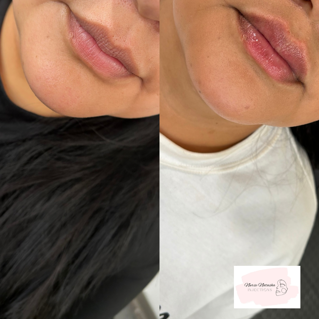 Full syringe done in two half syringe sessions